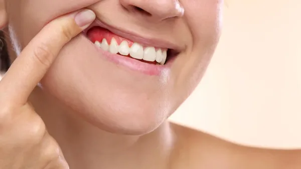 photo of This giant tropical fruit could help reverse gum disease damage image